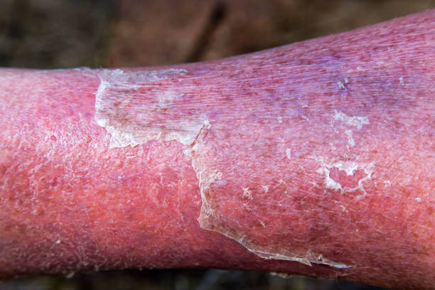 Cellulitis Infection: Is it contagious? | Symptoms, Treatment