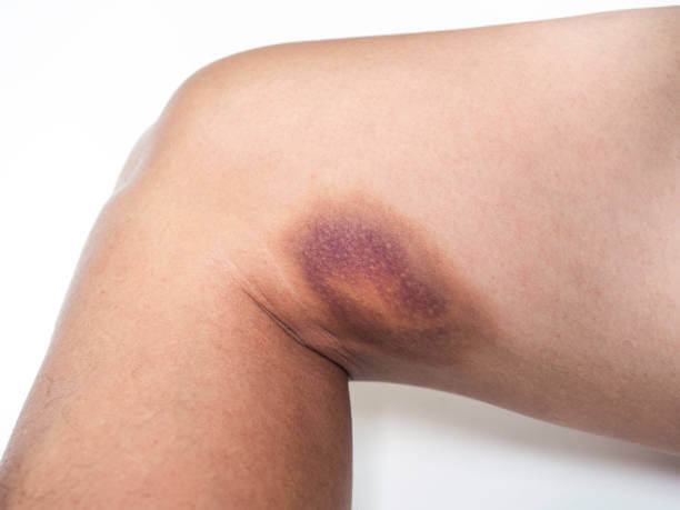 Hematoma: Types, Symptoms, Causes, Treatment