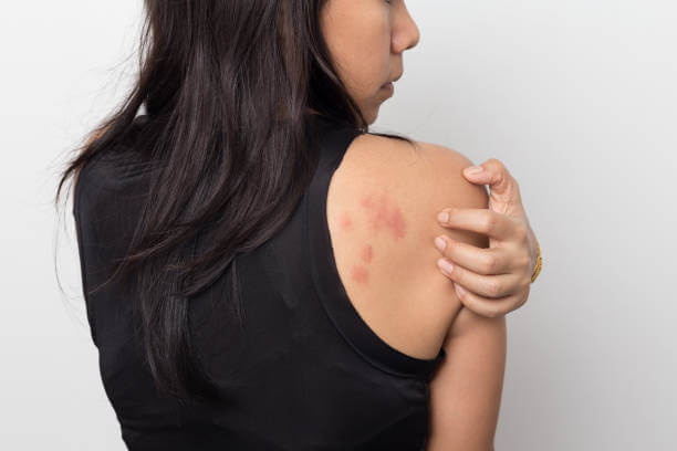 Hives Types, Causes, Symptoms, Treatment