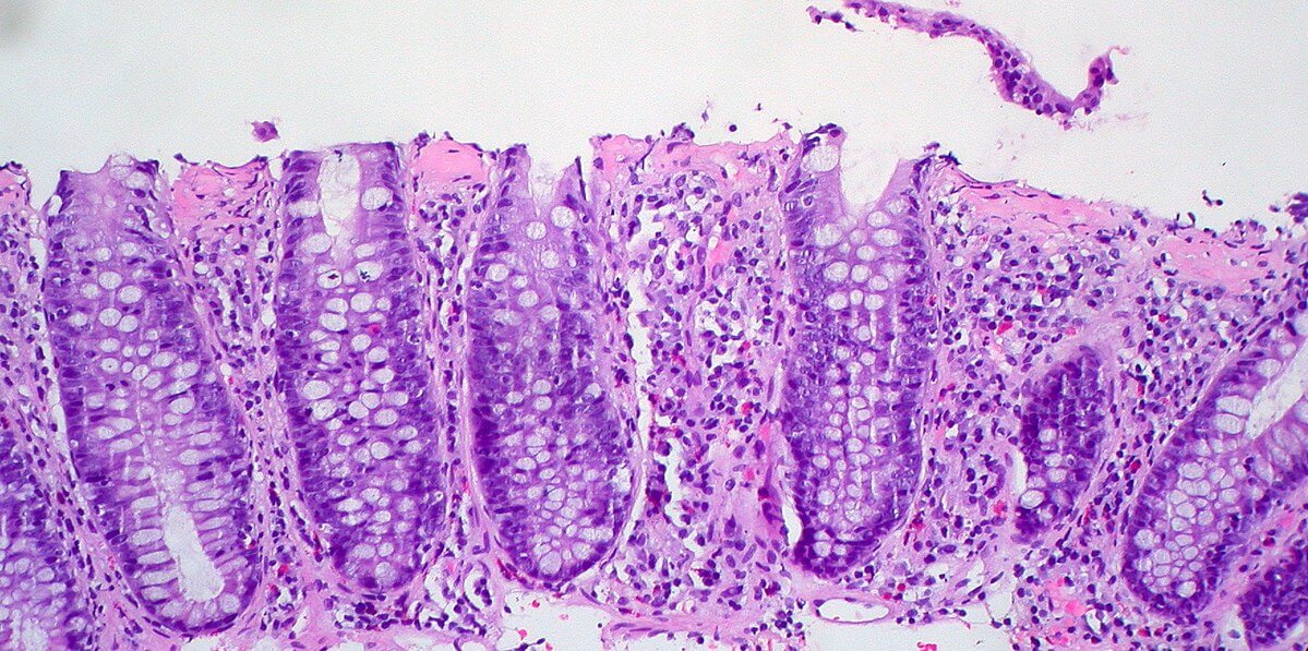 Collagenous Colitis: Symptoms and Treatment