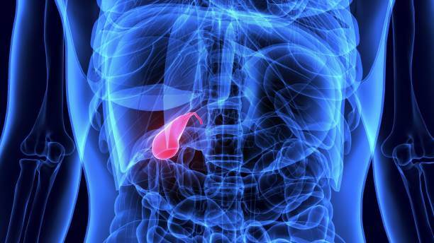 Foods to Avoid If You Have a Gallbladder Attack